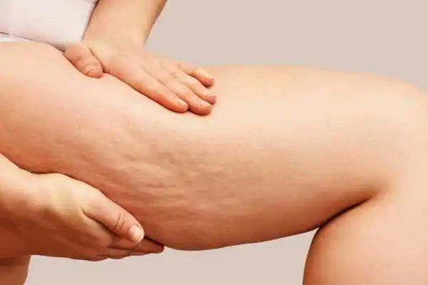 Image of woman showing leg with cellulite Ravenscliffe