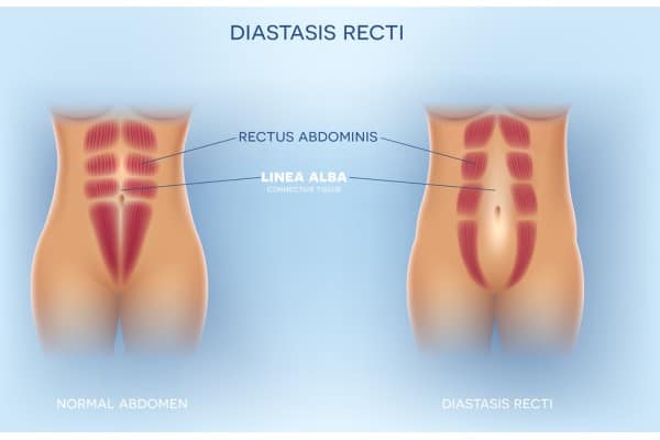 What Non-Surgical Options Are Available for Diastasis Recti Ravenscliffe?