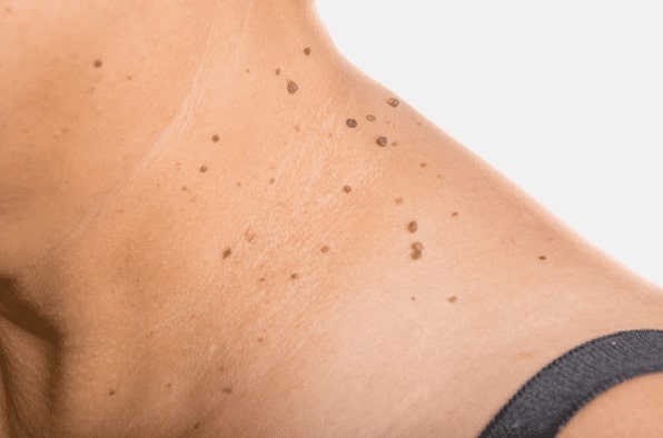 Are you looking for easy skin tag removal Ravenscliffe - then contact Spire today!