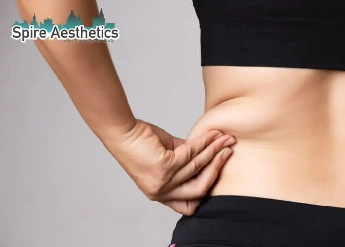 Image of woman pinching fat on their hips Ravenscliffe. Fat Freezing treatment