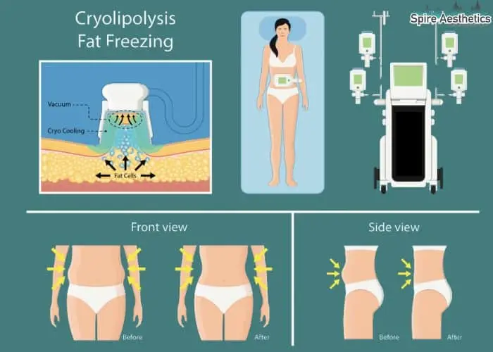 Fat freezing treatment Ravenscliffe benefits for competitions to remove stubborn fat deposits.