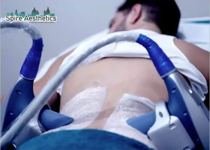 Man having fat freezing treatment done on love handles before a competitions Ravenscliffe to create a sculpted look.