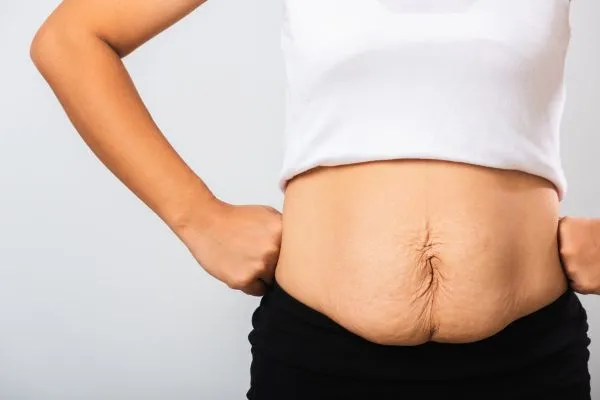 Image of a woman's stomach after weight loss with sagging skin following a gastric band Ravenscliffe