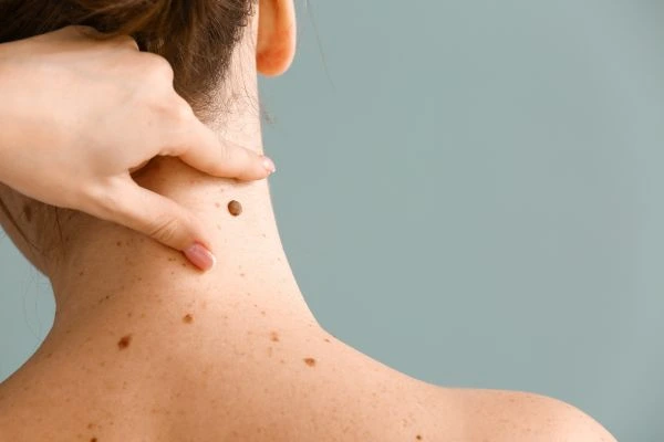 skin blemish removal Ravenscliffe treatment