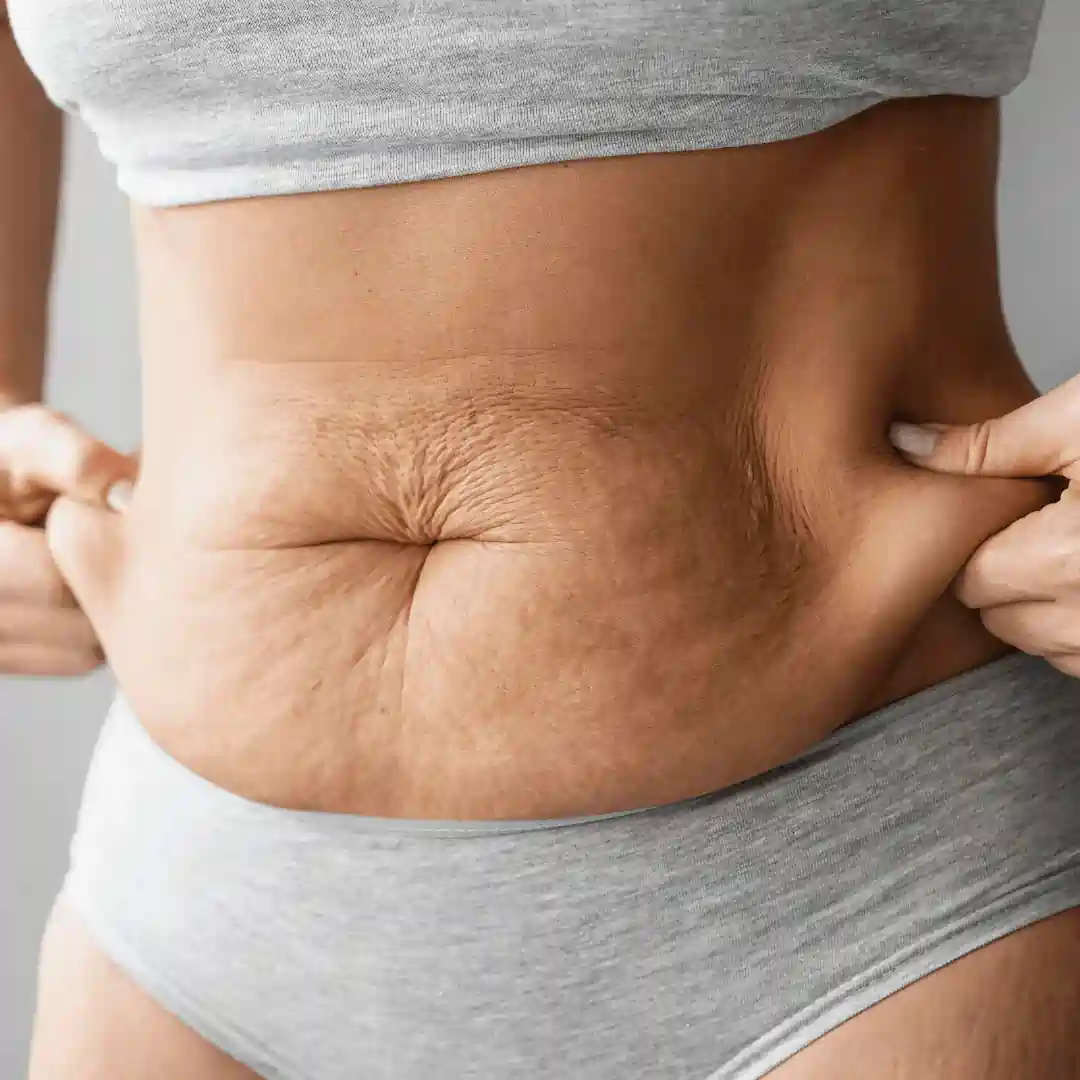 Is It Normal to Have Loose Skin After Pregnancy Ravenscliffe?